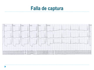 Falla de captura
 