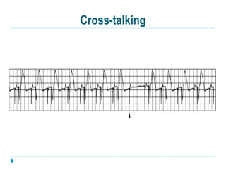 Cross-talking
 