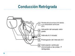 Conducción Retrógrada


            Pérdida del sincronismo AV debido
            a un extrasístole ventricular
            (EV)

            Activación del sensado retró-
            grado

            Intérvalo A-V iniciado

            Prolongación del intervalo A-V


            Estimulación ventricular
            sincronizada a las ondas P
            retrógradas
 