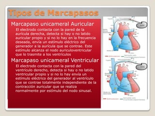 Tipos de Marcapasos
Marcapaso unicameral Auricular
 El electrodo contacta con la pared de la
 aurícula derecha, detecta si hay o no latido
 auricular propio y si no lo hay en la frecuencia
 deseada, envía un estímulo eléctrico del
 generador a la aurícula que se contrae. Este
 estímulo alcanza el nodo auriculoventricular
 que lo trasmite a los ventrículos
Marcapaso unicameral Ventricular
 El electrodo contacta con la pared del
 ventrículo derecho, detecta si hay o no latido
 ventricular propio y si no lo hay envía un
 estímulo eléctrico del generador al ventrículo
 que se contrae totalmente independiente de la
 contracción auricular que se realiza
 normalmente por estímulo del nodo sinusal.
 