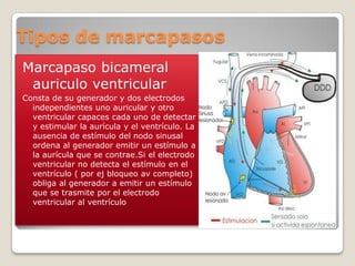 Tipos de marcapasos
Marcapaso bicameral
 auriculo ventricular
Consta de su generador y dos electrodos
  independientes uno auricular y otro
  ventricular capaces cada uno de detectar
  y estimular la aurícula y el ventrículo. La
  ausencia de estímulo del nodo sinusal
  ordena al generador emitir un estímulo a
  la aurícula que se contrae.Si el electrodo
  ventricular no detecta el estímulo en el
  ventrículo ( por ej bloqueo av completo)
  obliga al generador a emitir un estímulo
  que se trasmite por el electrodo
  ventricular al ventrículo
 