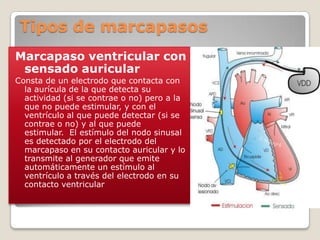 Tipos de marcapasos
Marcapaso ventricular con
 sensado auricular
Consta de un electrodo que contacta con
  la aurícula de la que detecta su
  actividad (si se contrae o no) pero a la
  que no puede estimular, y con el
  ventrículo al que puede detectar (si se
  contrae o no) y al que puede
  estimular. El estímulo del nodo sinusal
  es detectado por el electrodo del
  marcapaso en su contacto auricular y lo
  transmite al generador que emite
  automáticamente un estímulo al
  ventrículo a través del electrodo en su
  contacto ventricular
 