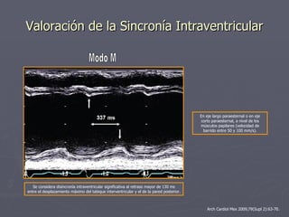 Evaluación Ecocardiográfica de la Sincronía Cardiaca | PPT