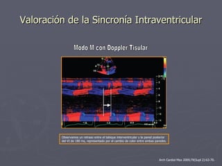 Evaluación Ecocardiográfica de la Sincronía Cardiaca | PPT