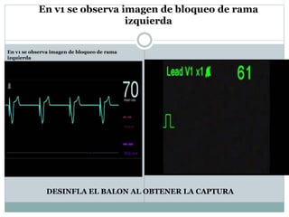 En v1 se observa imagen de bloqueo de rama
izquierda
En v1 se observa imagen de bloqueo de rama
izquierda
DESINFLA EL BALON AL OBTENER LA CAPTURA
 