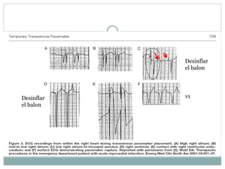 v1
Desinflar
el balon
Desinflar
el balon
 
