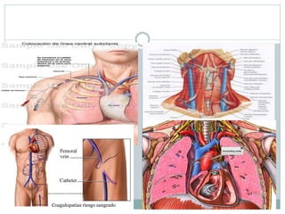 Coagulopatias riesgo sangrado
 