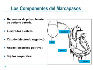 }  Generador de pulso: fuente
de poder o batería.
}  Electrodos o cables.
}  Cátodo (electrodo negativo).
}  Ánodo (electrodo positivo).
}  Tejidos corporales.
IPG
Electrodo
Anodo
Cátodo
Los Componentes del Marcapasos
 
