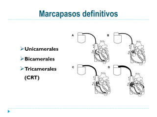 Marcapasos definitivos
Ø Unicamerales
Ø Bicamerales
Ø Tricamerales
(CRT)
 