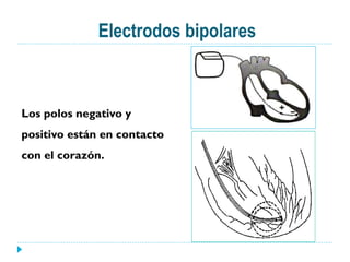 Electrodos bipolares
Los polos negativo y
positivo están en contacto
con el corazón.
 