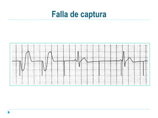 Falla de captura
 