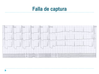 Falla de captura
 