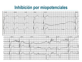 Inhibición por miopotenciales
 