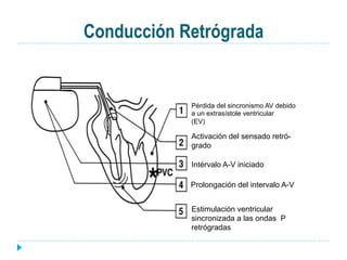 Conducción Retrógrada
Pérdida del sincronismo AV debido
a un extrasístole ventricular
(EV)
Activación del sensado retró-
grado
Intérvalo A-V iniciado
Prolongación del intervalo A-V
Estimulación ventricular
sincronizada a las ondas P
retrógradas
 