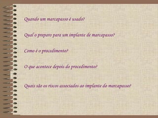 Quando um marcapasso é usado?


Qual o preparo para um implante de marcapasso?


Como é o procedimento?


O que acontece depois do procedimento?


Quais são os riscos associados ao implante do marcapasso?
 