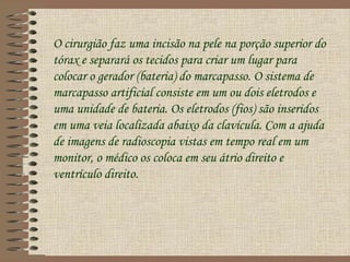 O cirurgião faz uma incisão na pele na porção superior do
tórax e separará os tecidos para criar um lugar para
colocar o gerador (bateria) do marcapasso. O sistema de
marcapasso artificial consiste em um ou dois eletrodos e
uma unidade de bateria. Os eletrodos (fios) são inseridos
em uma veia localizada abaixo da clavícula. Com a ajuda
de imagens de radioscopia vistas em tempo real em um
monitor, o médico os coloca em seu átrio direito e
ventrículo direito.
 