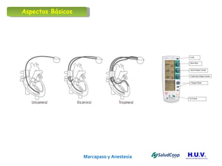 Marcapaso y Anestesia   Aspectos Básicos 