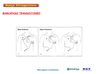 Marcapaso y Anestesia   MARCAPASO TRANSCUTANEO Manejo Intraoperatorio 