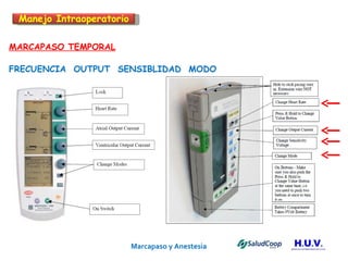 Marcapaso y Anestesia   MARCAPASO TEMPORAL FRECUENCIA  OUTPUT  SENSIBLIDAD  MODO Manejo Intraoperatorio 