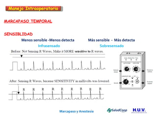 Marcapaso y Anestesia   MARCAPASO TEMPORAL SENSIBLIDAD  Menos sensible -Menos detecta  Más sensible  -  Más detecta  Infrasensado  Sobresensado Manejo Intraoperatorio 