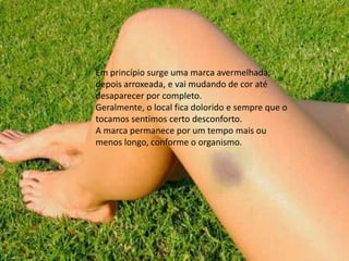 Em princípio surge uma marca avermelhada,
depois arroxeada, e vai mudando de cor até
desaparecer por completo.
Geralmente, o local fica dolorido e sempre que o
tocamos sentimos certo desconforto.
A marca permanece por um tempo mais ou
menos longo, conforme o organismo.
 