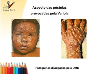 Aspecto das pústulas
provocadas pela Varíola




  Fotografias divulgadas pela OMS
 