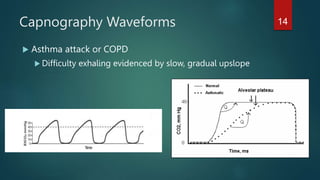 Capnography Waveforms
 Asthma attack or COPD
 Difficulty exhaling evidenced by slow, gradual upslope
14
 