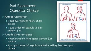 Pad Placement
Operator Choice
 Anterior /posterior
 1 pad over apex of heart, under left
breast
 1 pad under left scapula in line with
anterior pad
 Anterior/anterior (apex)
 Anterior pad on right upper sternum just below
clavicle
 Apex pad below left nipple in anterior axillary line over apex
of heart
29
 