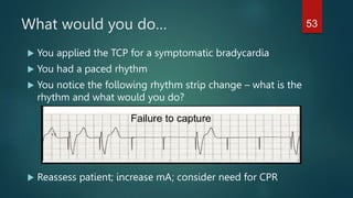 What would you do…
 You applied the TCP for a symptomatic bradycardia
 You had a paced rhythm
 You notice the following rhythm strip change – what is the
rhythm and what would you do?
 Reassess patient; increase mA; consider need for CPR
Failure to capture
53
 