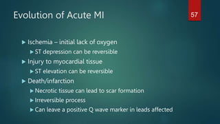Evolution of Acute MI
 Ischemia – initial lack of oxygen
 ST depression can be reversible
 Injury to myocardial tissue
 ST elevation can be reversible
 Death/infarction
 Necrotic tissue can lead to scar formation
 Irreversible process
 Can leave a positive Q wave marker in leads affected
57
 