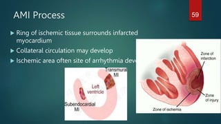 AMI Process
 Ring of ischemic tissue surrounds infarcted
myocardium
 Collateral circulation may develop
 Ischemic area often site of arrhythmia development
59
 