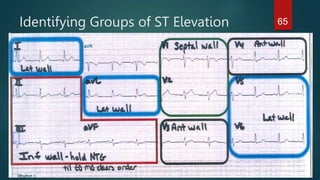 Identifying Groups of ST Elevation 65
 