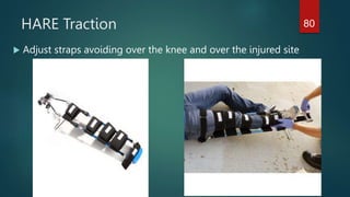 HARE Traction
 Adjust straps avoiding over the knee and over the injured site
80
 