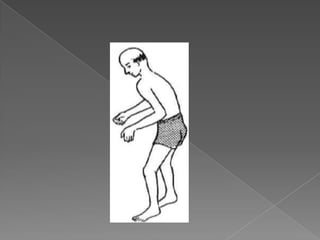 MarchaparaplejicaLesiones medularesCaracterísticas:Cuando la lesión se encuentra en D2 y hasta L1, marcha pendular trípode. Si la lesión se encuentra entre las vertebras L1 y L5 marcha paso a paso, pero no es normal desde el punto de vista fisiológico. Inferior a L5 marcha a cuatro pasos con discreta toma del tobillo.