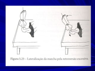 Marcha normal e_patologica