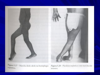 Marcha normal e_patologica