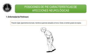 1. Enfermedad de Parkinson:
Posición rígida, ligeramente encorvada, miembros superiores adosados al tronco. Existe un temblor grosero de reposo.
POSICIONES DE PIE CARACTERÍSTICAS DE
AFECCIONES NEUROLÓGICAS
 