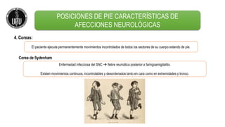 4. Coreas:
Enfermedad infecciosa del SNC  fiebre reumática posterior a faringoamigdalitis.
Existen movimientos continuos, incontrolables y desordenados tanto en cara como en extremidades y tronco.
POSICIONES DE PIE CARACTERÍSTICAS DE
AFECCIONES NEUROLÓGICAS
El paciente ejecuta permanentemente movimientos incontrolados de todos los sectores de su cuerpo estando de pie.
Corea de Sydenham
 
