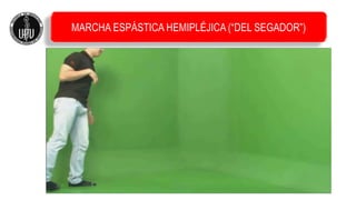 MARCHA ESPÁSTICA HEMIPLÉJICA (“DEL SEGADOR”)
 