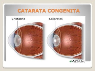 CATARATA CONGENITA
 