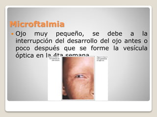 Microftalmia
 Ojo muy pequeño, se debe a la
interrupción del desarrollo del ojo antes o
poco después que se forme la vesícula
óptica en la 4ta semana.
 