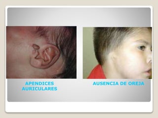 APENDICES
AURICULARES
AUSENCIA DE OREJA
 