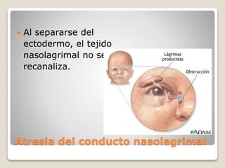 Atresia del conducto nasolagrimal
 Al separarse del
ectodermo, el tejido
nasolagrimal no se
recanaliza.
 