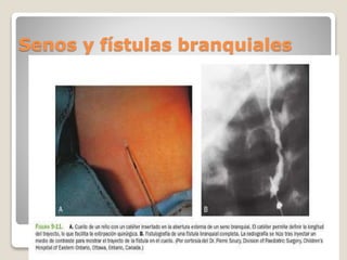Senos y fístulas branquiales
 