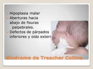 Síndrome de Treacher Collins
 Hipoplasia malar
 Aberturas hacia
abajo de fisuras
palpebrales.
 Defectos de párpados
inferiores y oído externo.
 