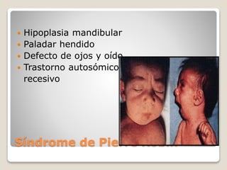 Síndrome de Pierre Robin
 Hipoplasia mandibular
 Paladar hendido
 Defecto de ojos y oído
 Trastorno autosómico
recesivo
 