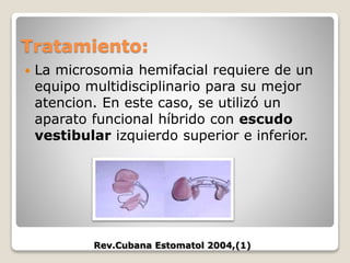 Tratamiento:
 La microsomia hemifacial requiere de un
equipo multidisciplinario para su mejor
atencion. En este caso, se utilizó un
aparato funcional híbrido con escudo
vestibular izquierdo superior e inferior.
Rev.Cubana Estomatol 2004,(1)
 