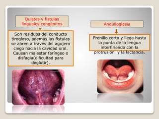 Quistes y fistulas
linguales congénitos
Son residuos del conducto
tirogloso, además las fistulas
se abren a través del agujero
ciego hacia la cavidad oral.
Causan malestar faríngeo o
disfagia(dificultad para
deglutir).
Anquiloglosia
Frenillo corto y llega hasta
la punta de la lengua
interfiriendo con la
protrusión y la lactancia.
 