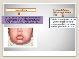 macroglosia
Consecuencia de la hipertrofia debido
mayormente a un linfagioma(tumor
linfático) o a hipertrofia muscular.
Lengua bífida o
hendida(glososqui
sis)
Fusión incompleta de las
yemas distales de la
lengua produce un surco
medio profundo en ella.
 