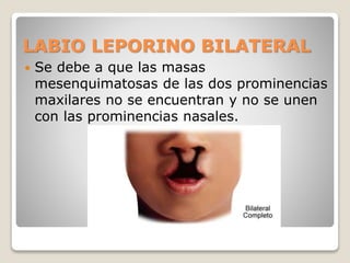 LABIO LEPORINO BILATERAL
 Se debe a que las masas
mesenquimatosas de las dos prominencias
maxilares no se encuentran y no se unen
con las prominencias nasales.
 